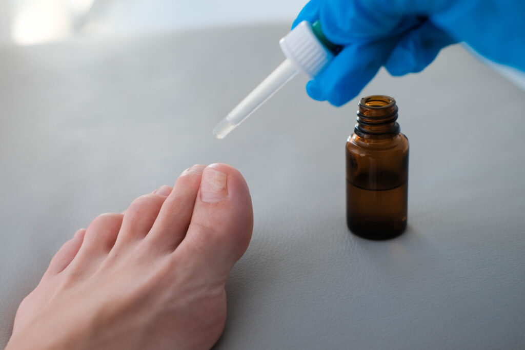 Nail Fungus Treatments. A doctor in medical gloves drips medicine from a pipette onto a sore finger. Close-up of a foot with nail fungus. Onycholysis: detachment of the nail from the nail bed.