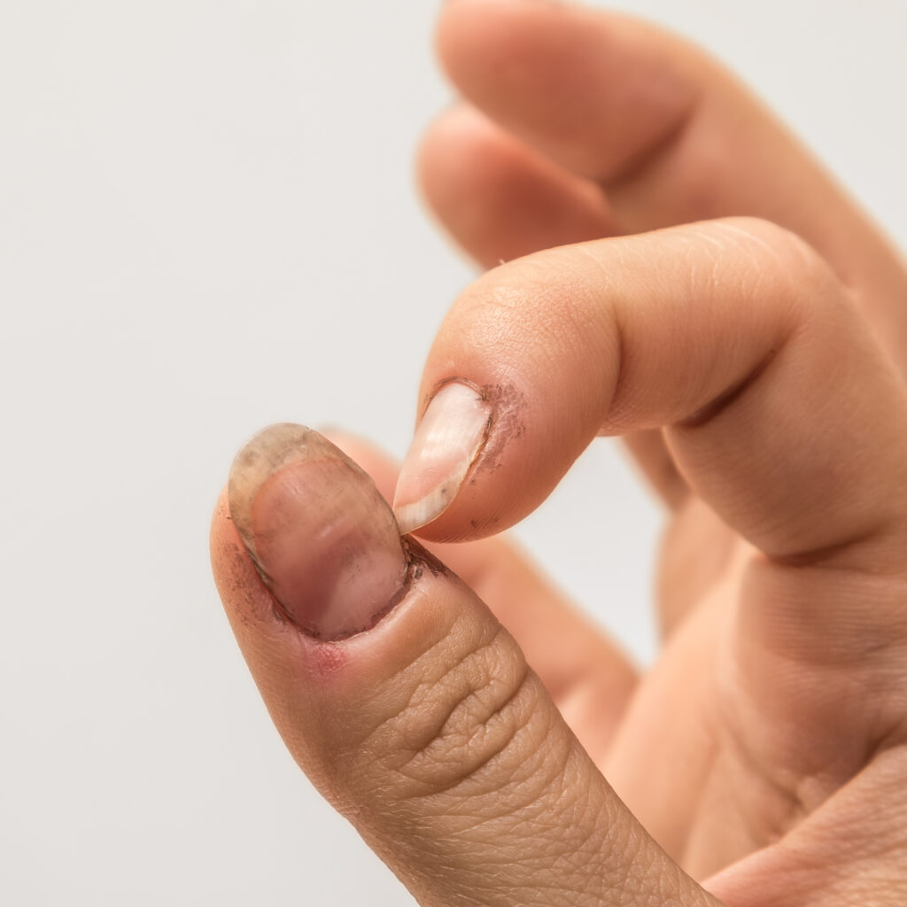 Female hands with dirty nails. Not cleaning nails perfectly from nail polish.