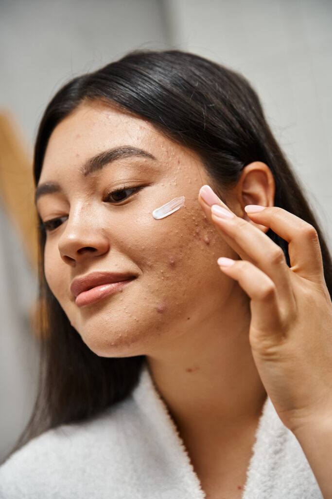 acne treatment cream on face of young asian woman with brunette hair looking away, close up. DIY facial care.