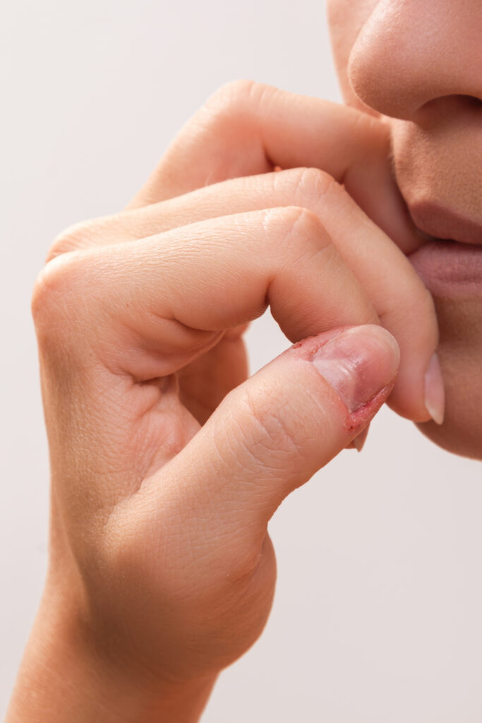 Close up of a female mouth biting her fingers. Biting Nails = Health Risks