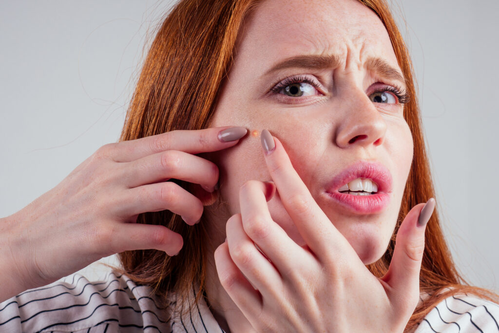 redhead student woman squeezing her pimples, removing pimple from her face white background studio. DIY face care. home facial care.