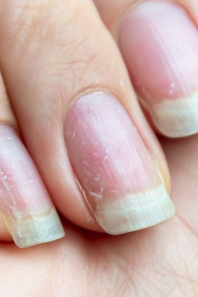 Got Thin, Peeling, or Cracked Nails. How to Treat Cracked Nails at Home.  illness nails.