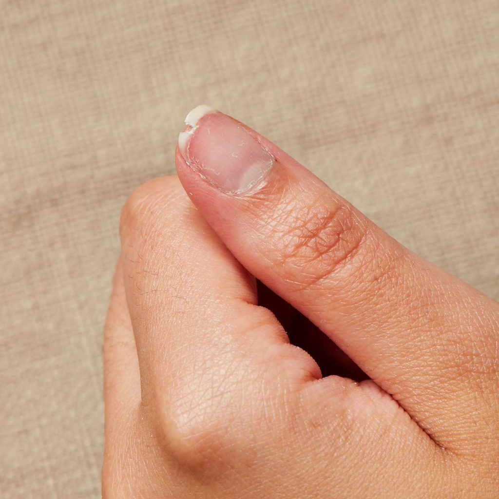 How to Identify Different Types of Nail Cracks. treat cracked nails. illness nails.