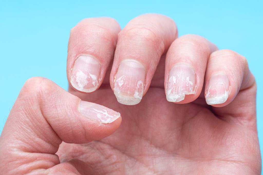 Flaky bitten and brittle nails without a manicure. Regrown nail cuticle and damaged nail plate after gel polish on blue background. broken nails.