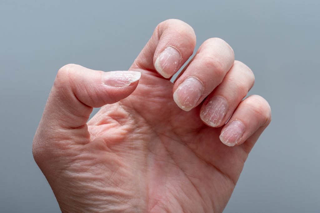 Detailed close-up of a hand showing brittle, dry, and peeling nails, with dehydrated skin on a neutral gray background. Concept of nail health. negative impact of stress on nail health. Understanding What Damages Nail Health